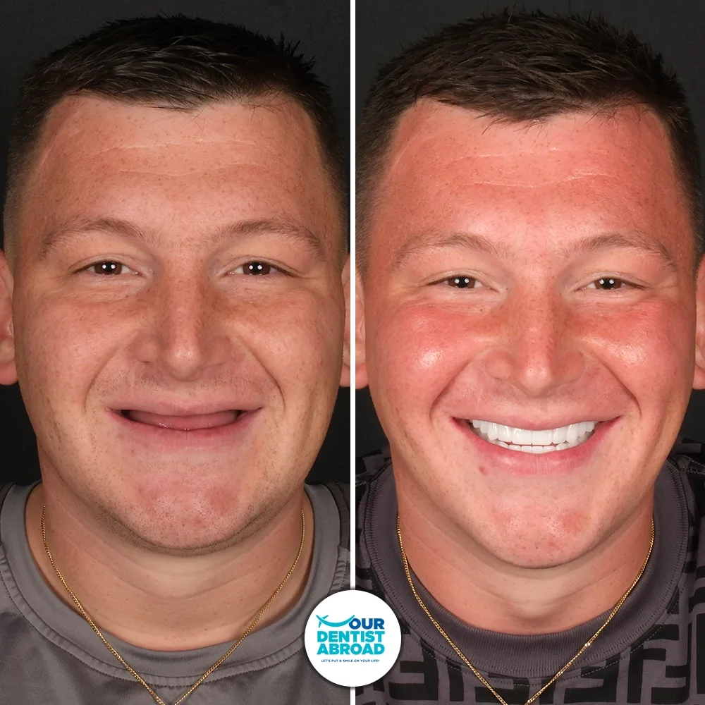 All-on-6 dental implants before and after