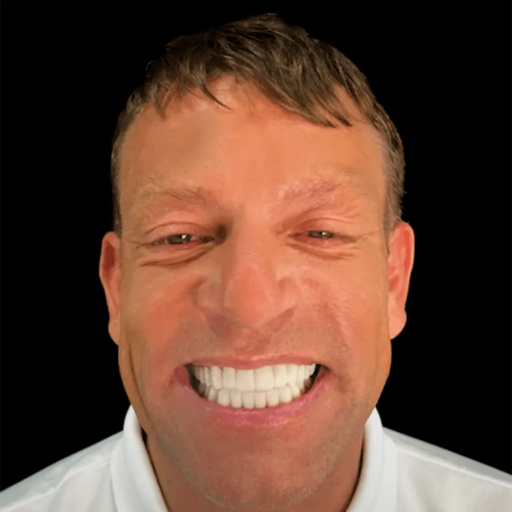 Laminat-Veneers Ergebnis