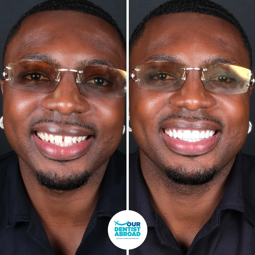 E-max crowns before and after