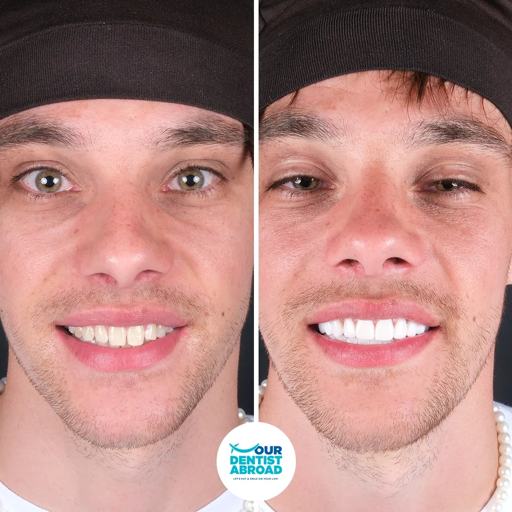 E-max restoration before and after