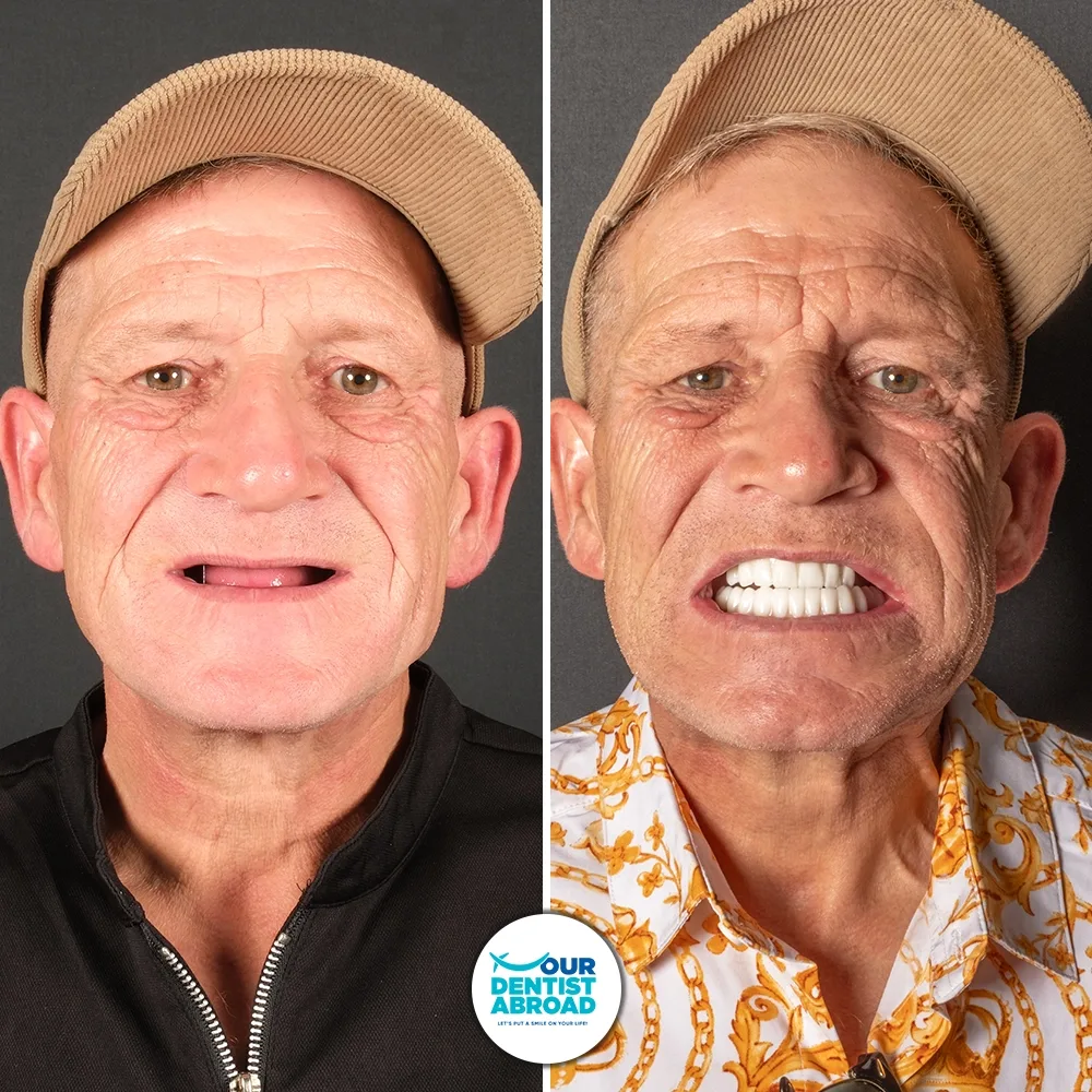 All-on-4 dental implants before and after