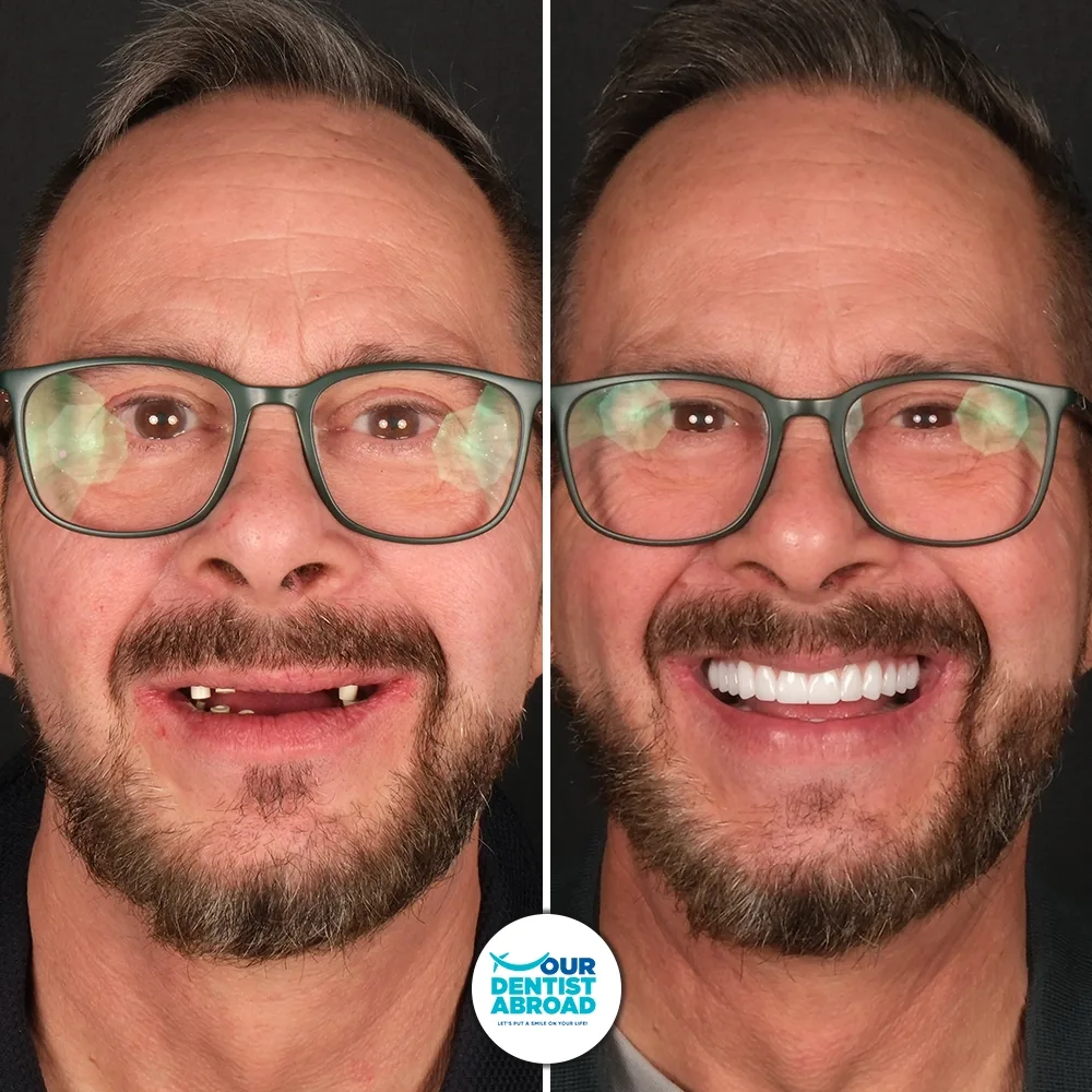 All-on-4 dental implants before and after