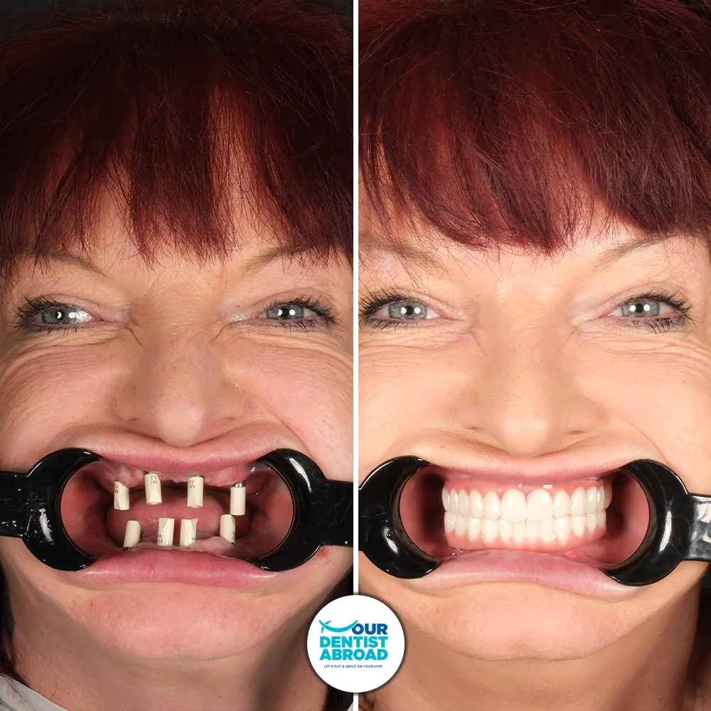 All-on-4 dental implants before and after
