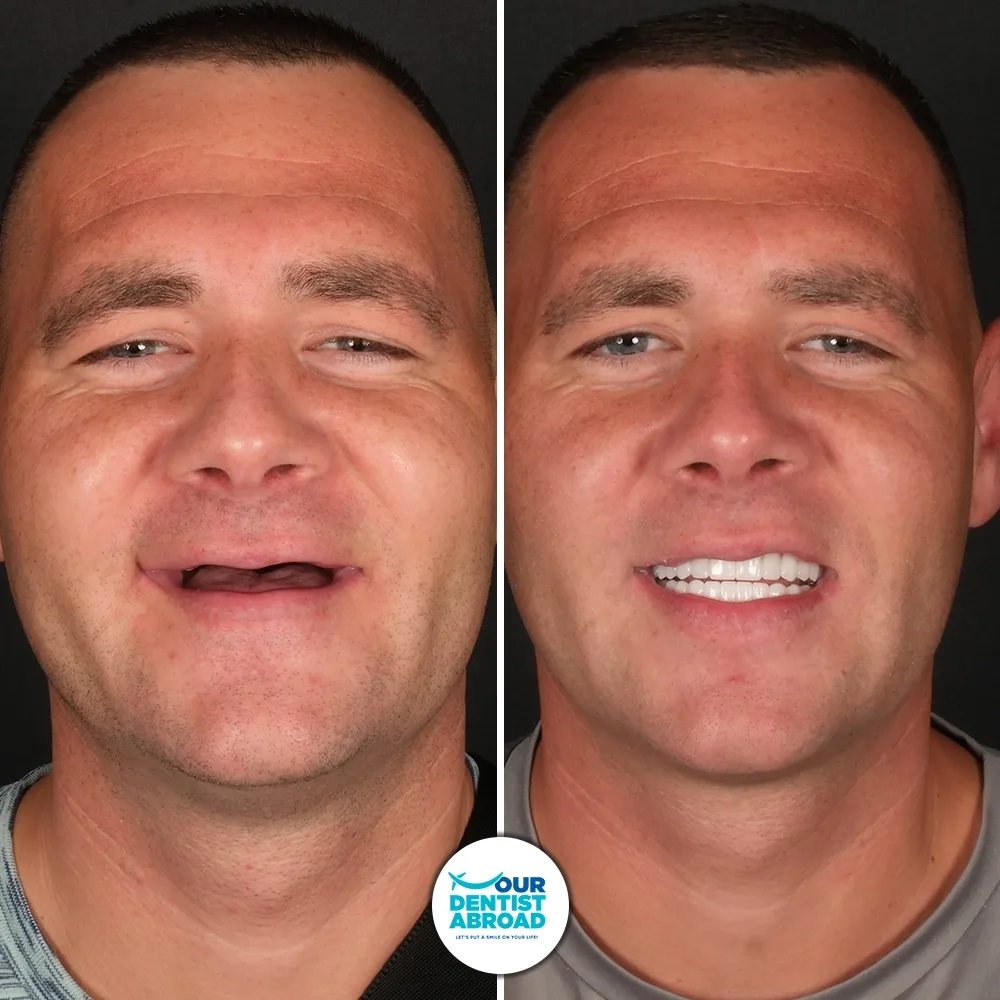 All-on-6 dental implants before and after