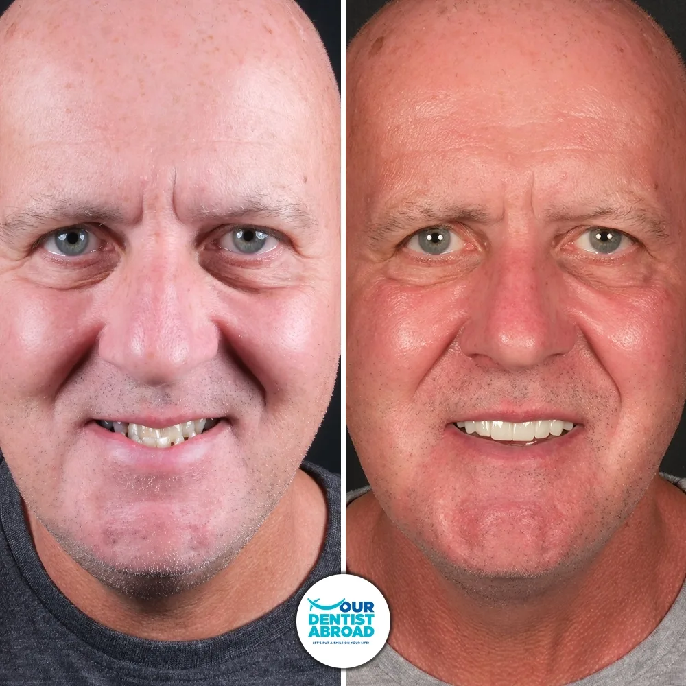 All-on-6 dental implants before and after