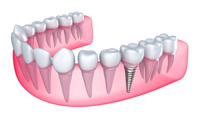 dental-implant1